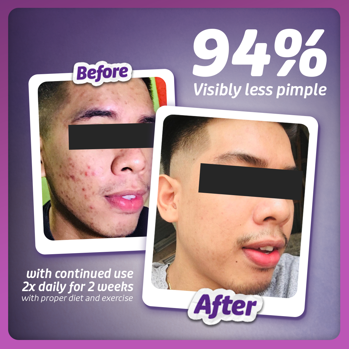 Lactezin 100mg Anti-Acne 30 capsules + FREE Lactezin Pouch