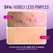 Lactezin Anti-Acne 100s Box